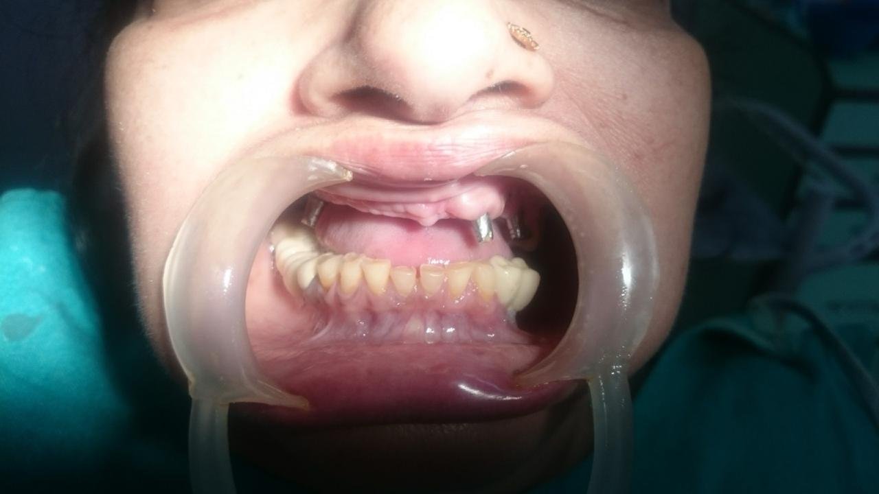 Dental Implant Before - Central Polyclinic